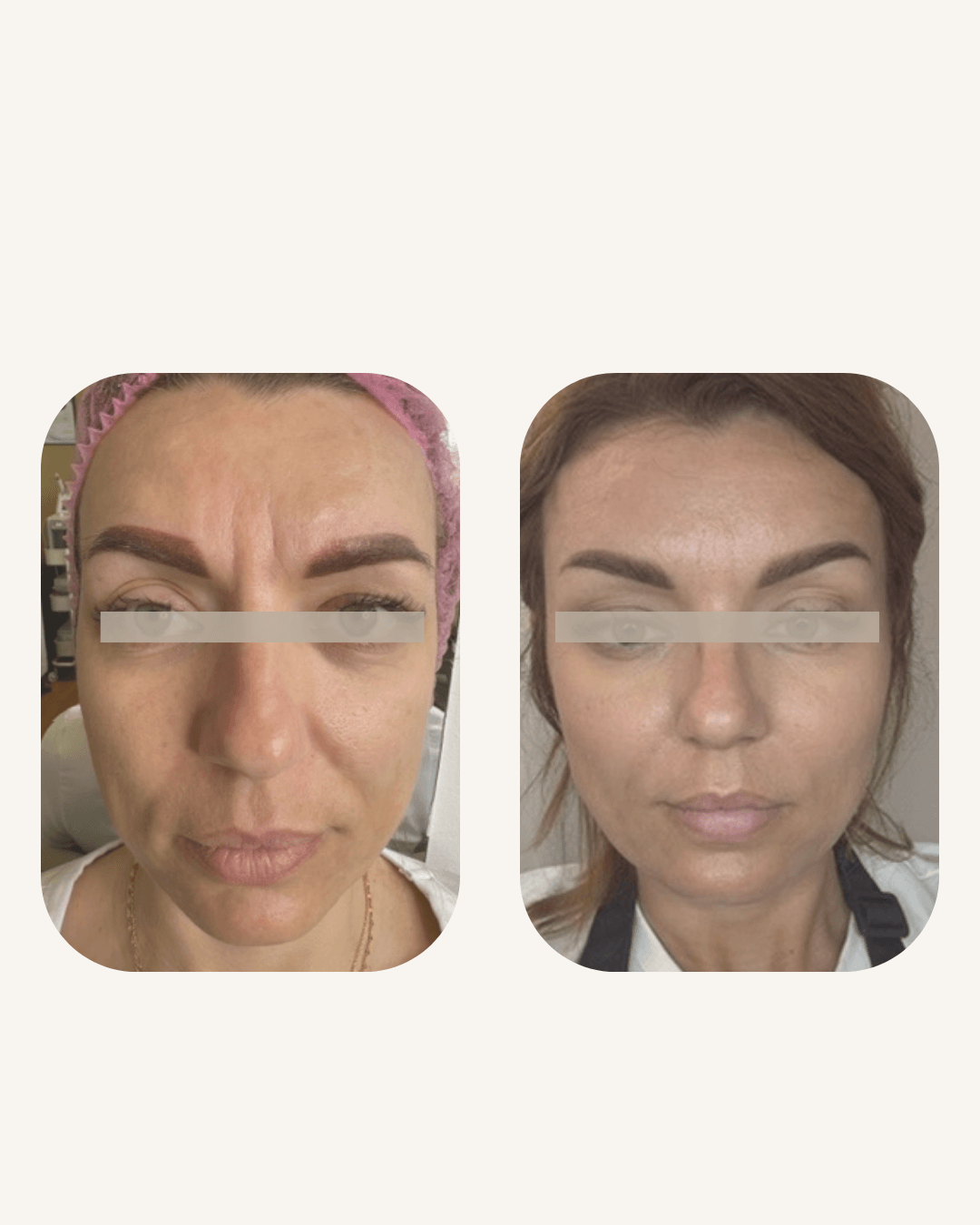 Full Face prije i poslije